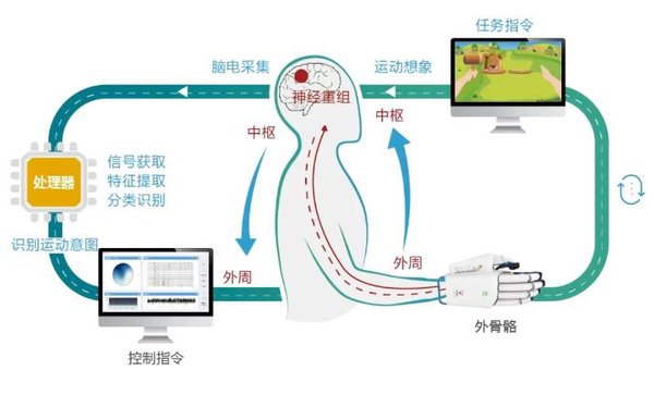 帕金森老人靠脑机接口重获行走